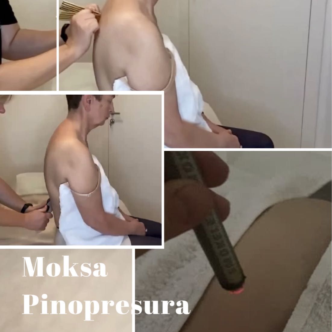 Portfolio usługi Moksoterapia z pinopresurą