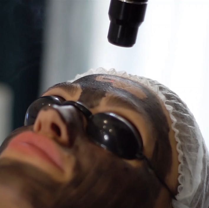 Portfolio usługi Laserowy Peeling Węglowy twarz+szyja