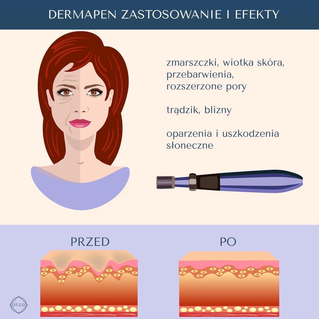 Portfolio usługi Mezoterapia mikroigłowa DermaPen + oczyszczanie