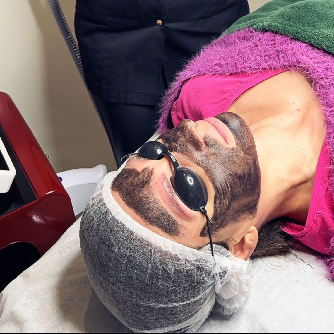 Portfolio usługi Laserowy Peeling Węglowy twarzy