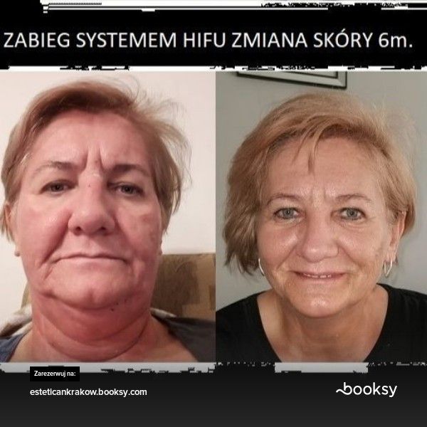Portfolio usługi Zabieg Lifting twarz + szyja - systemem HIFU