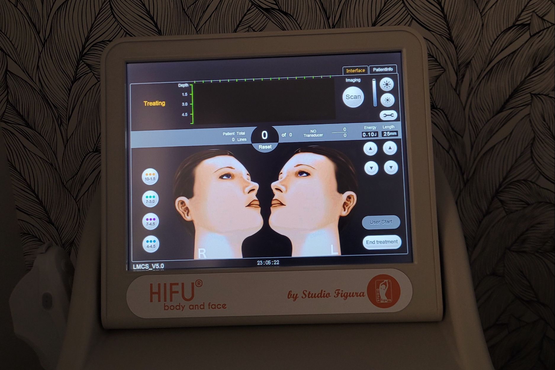 Portfolio usługi HIFU - policzki + linia żuchwy