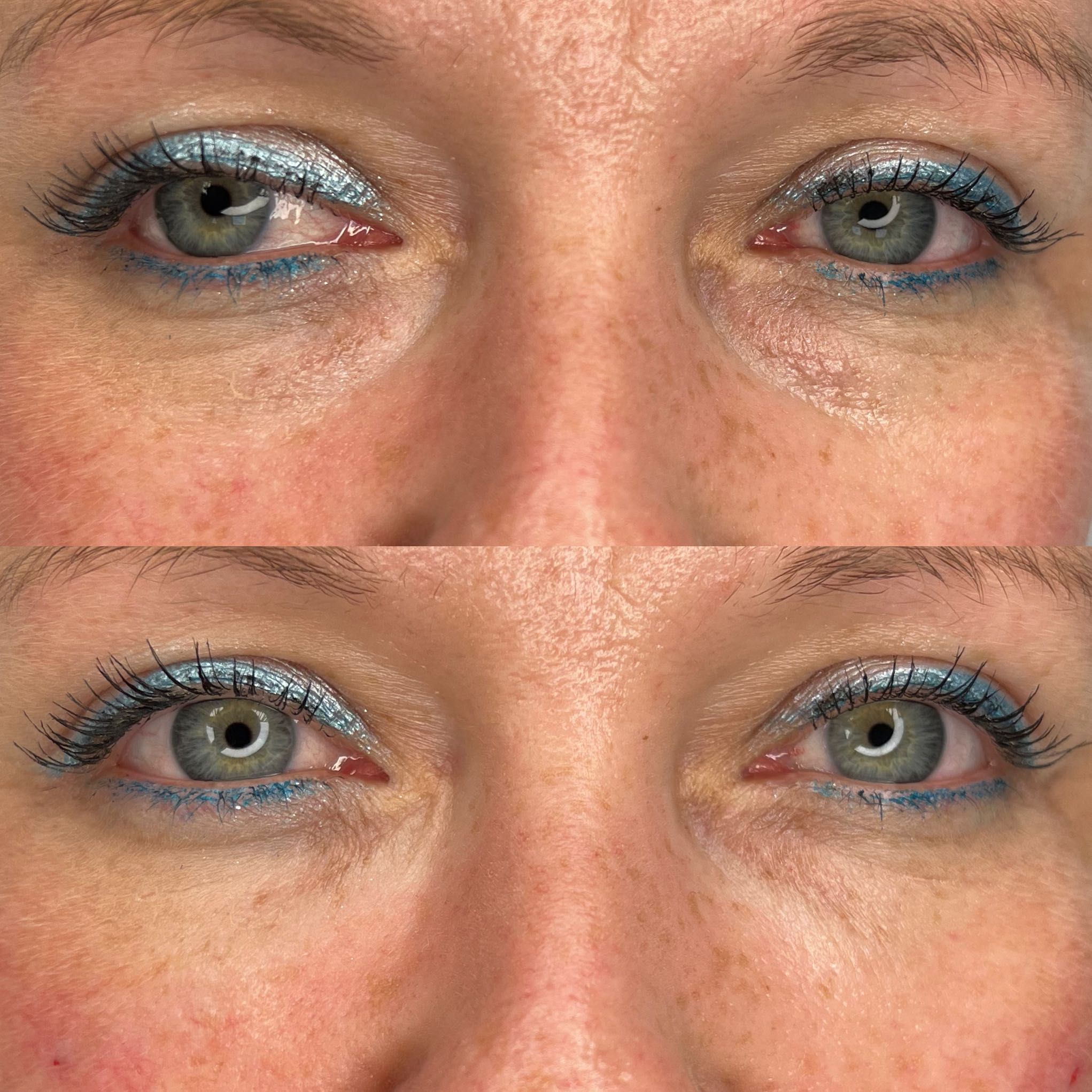 Portfolio usługi Stymulator tkankowy okolica oka