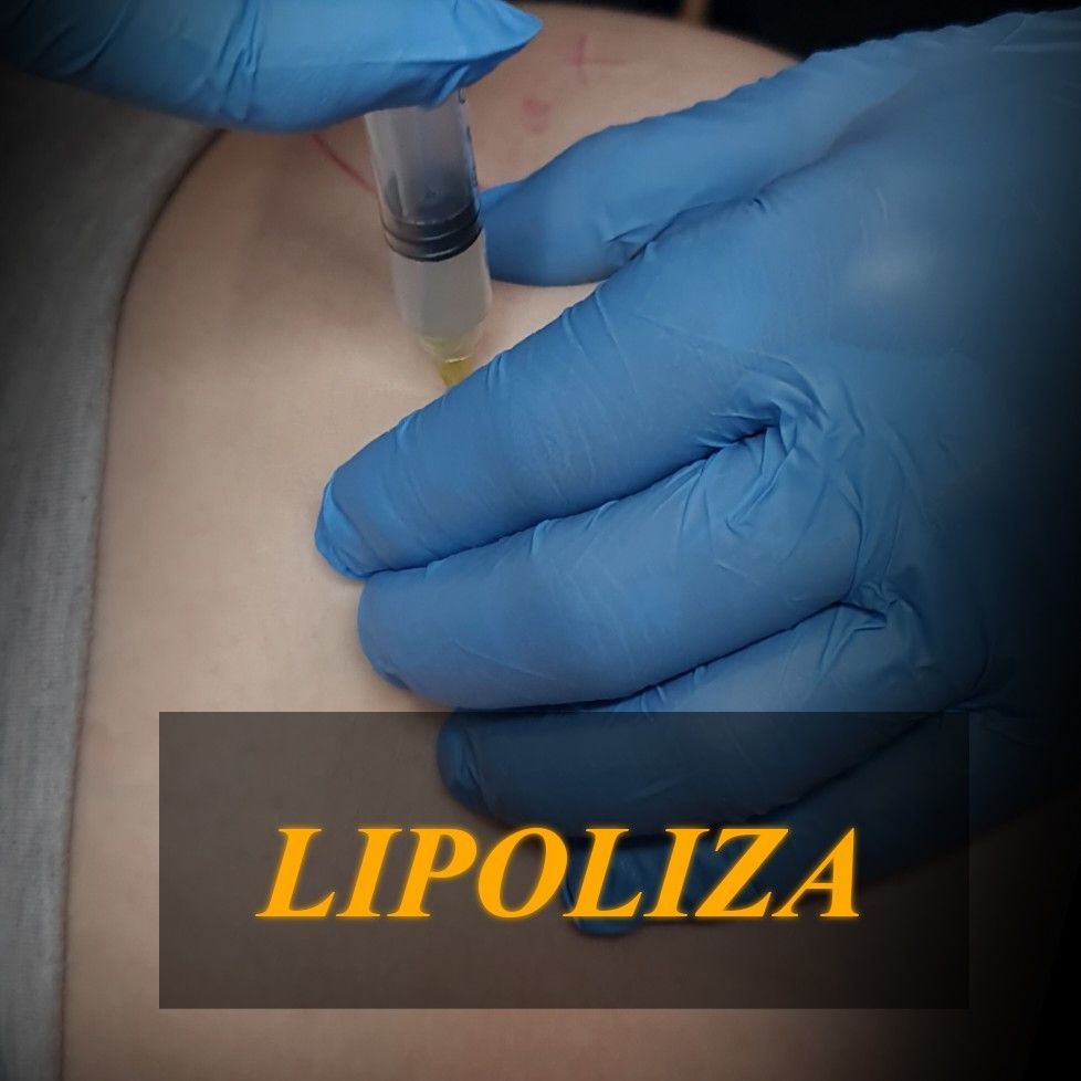 Portfolio usługi Lipoliza iniekcyjna brzuch 10ml
