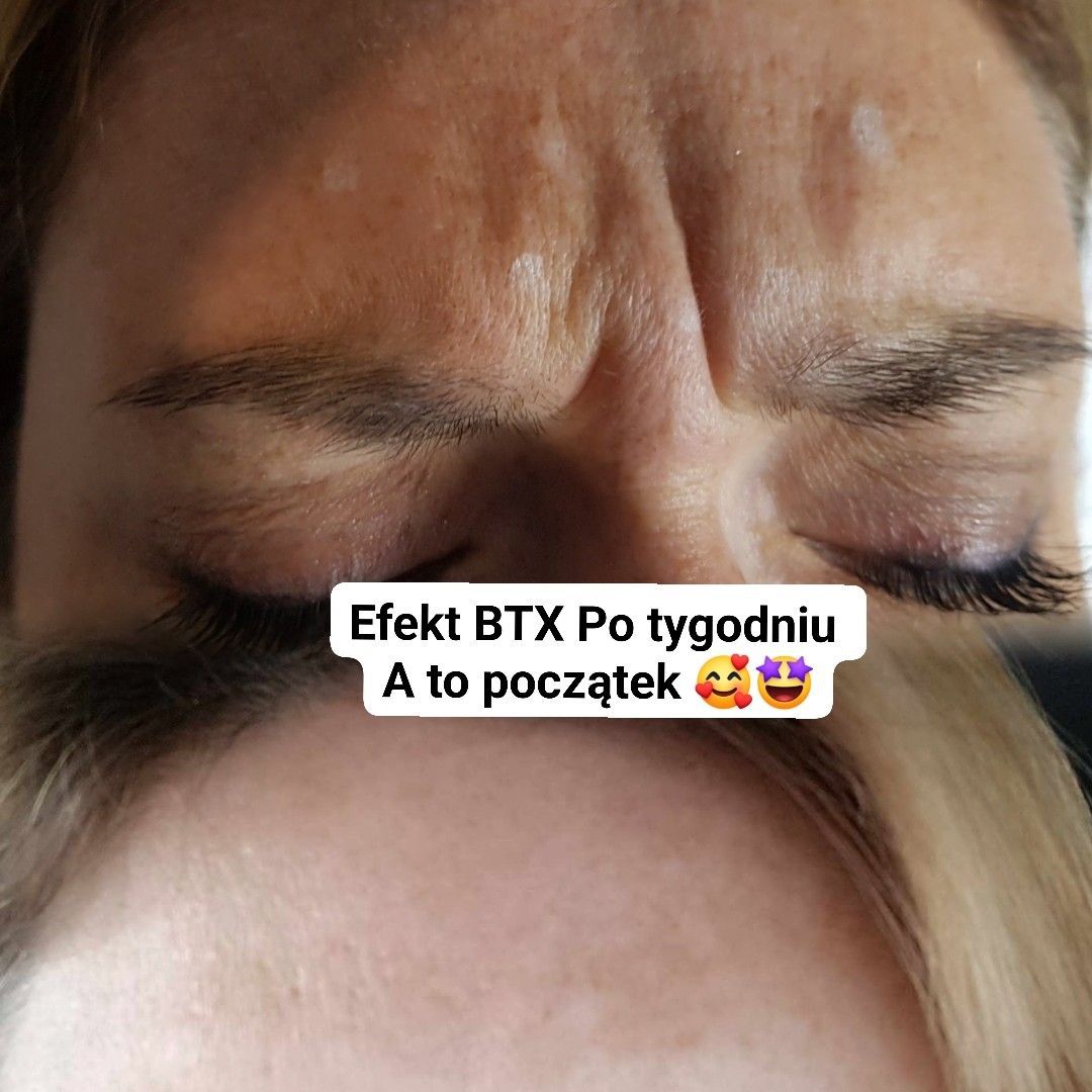 Portfolio usługi BTX Lwia Zmarszczka