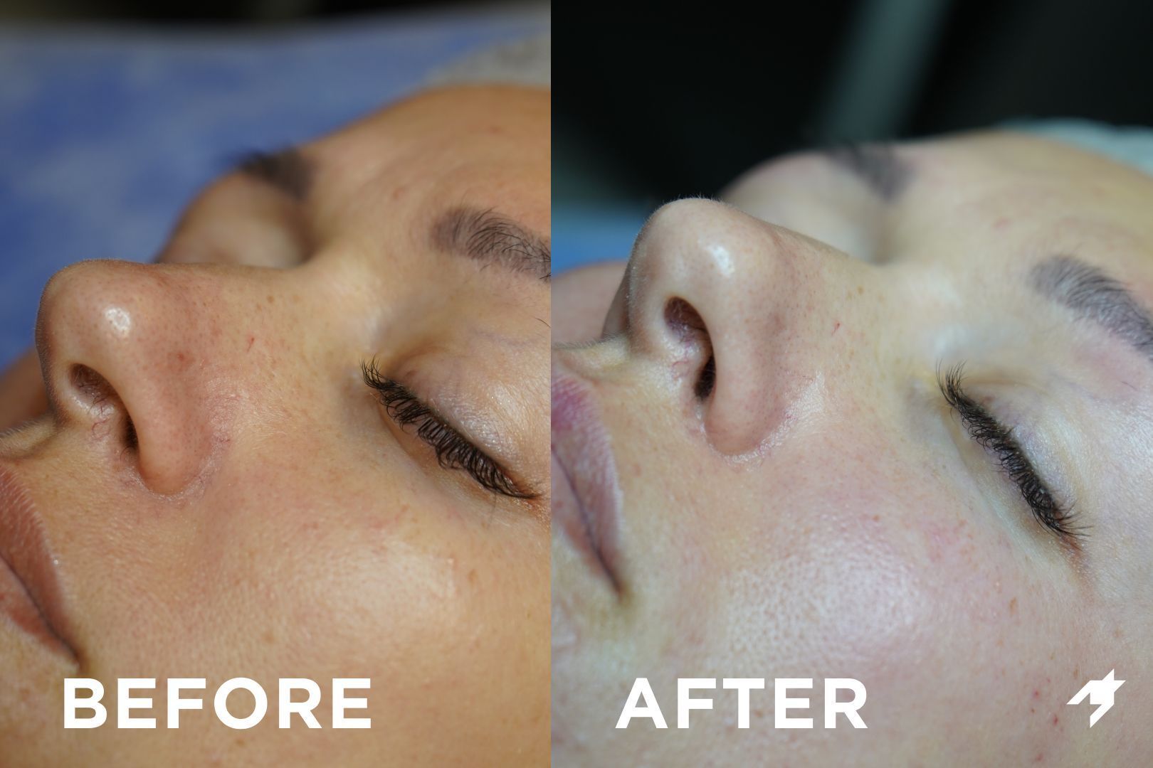 Portfolio usługi Laserowe odmładzanie twarz + szyja