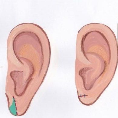 Portfolio usługi Zmniejszenie płatków uszu