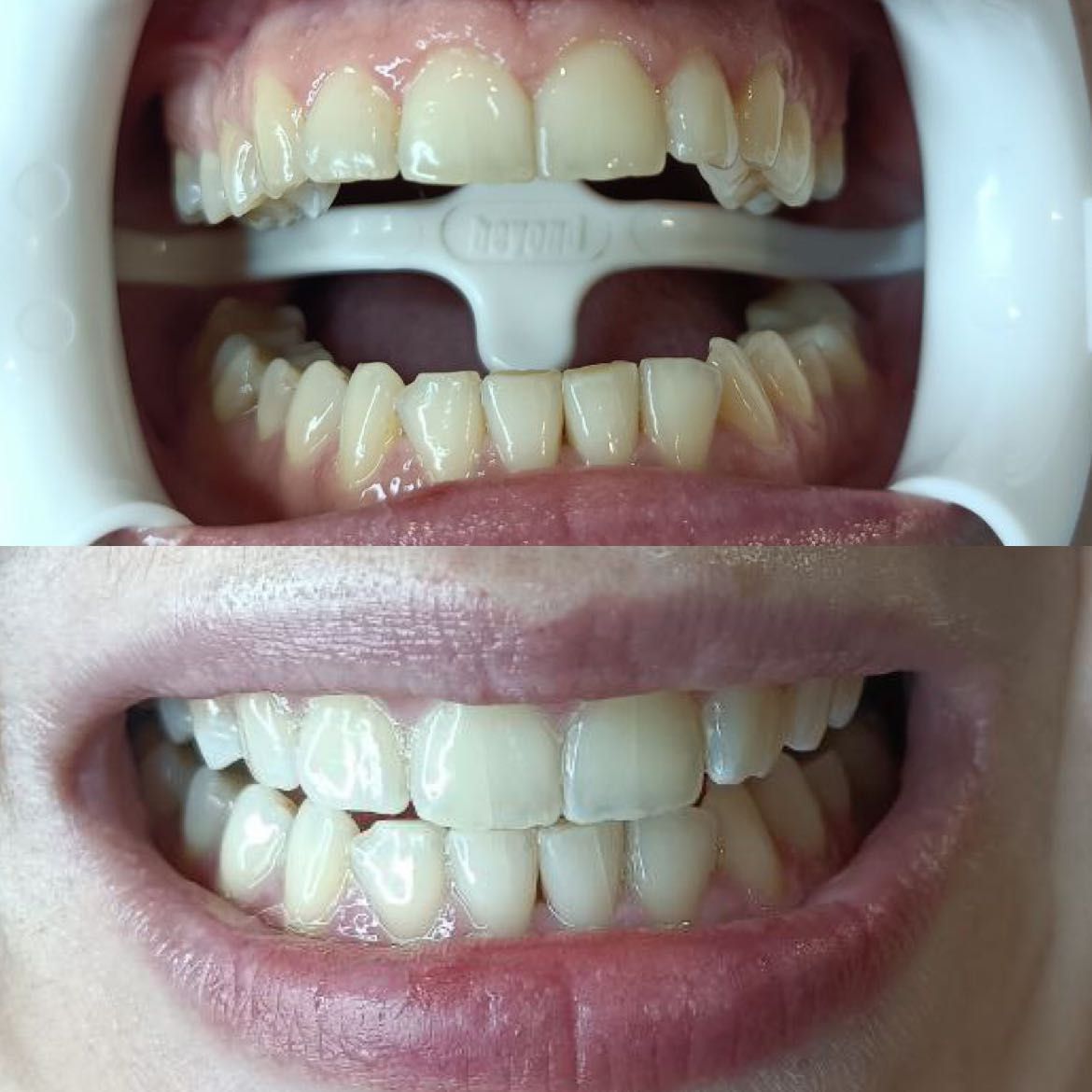 Portfolio usługi Kosmetyczne Wybielanie zębów - 1 ząb