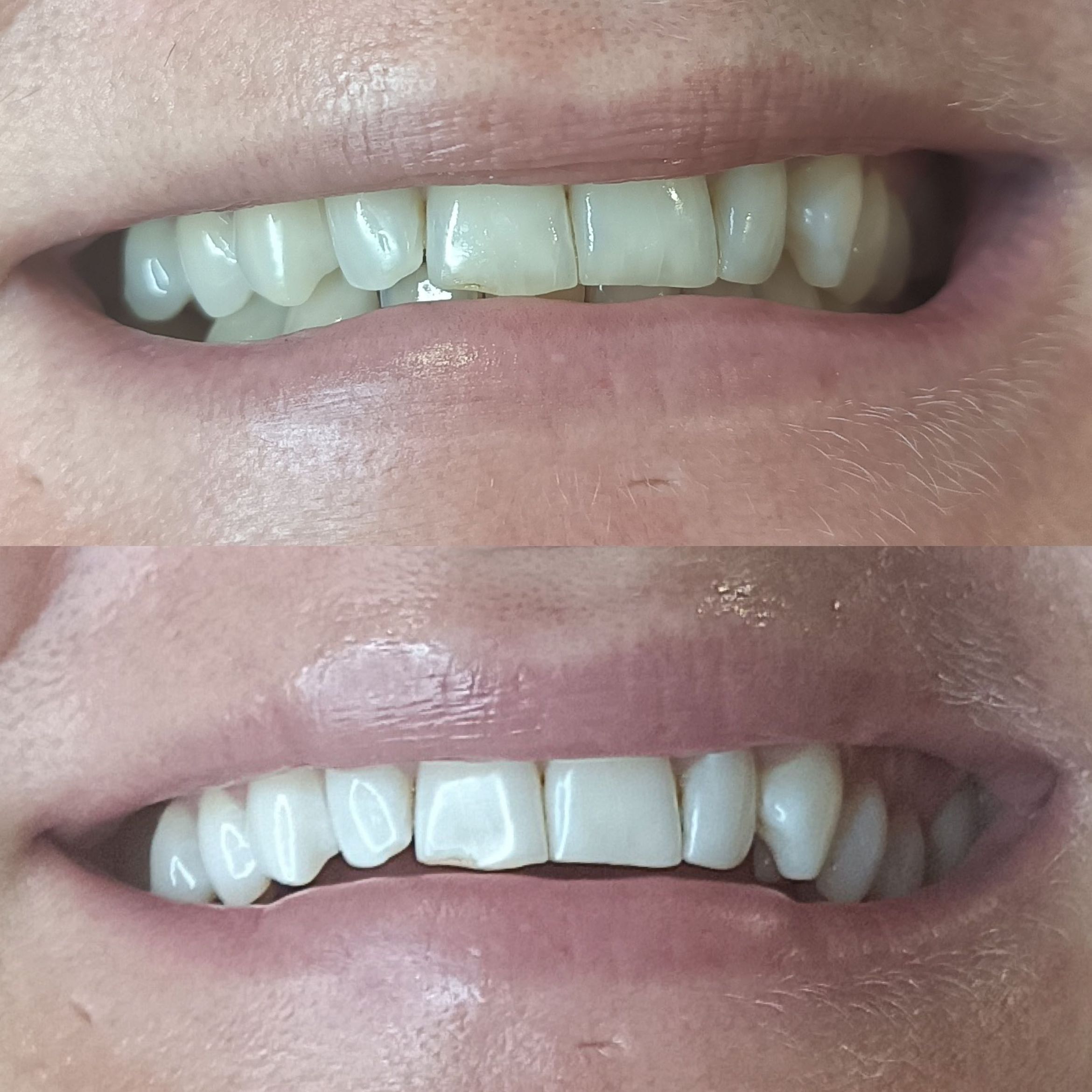 Portfolio usługi Wybielanie metodą Beyond - 1 ząb