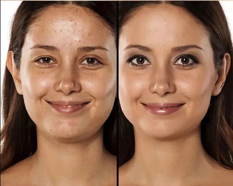 Portfolio usługi Meso BB Glam/zabieg do pigmentacji skóry twarzy