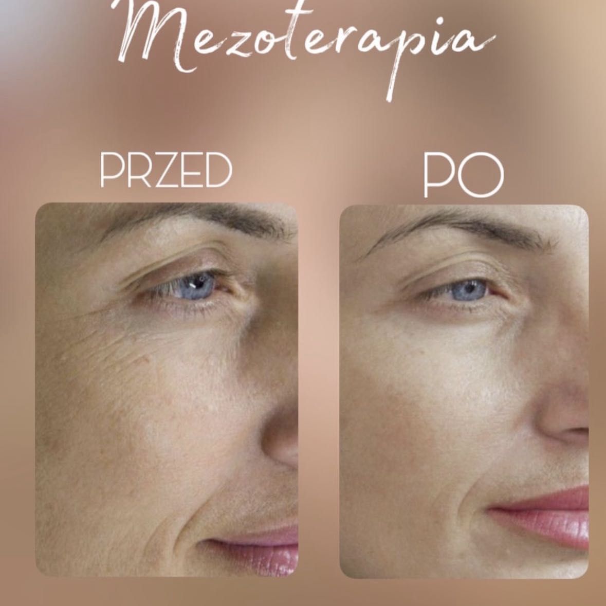 Portfolio usługi Mezoterapia okolic oczu