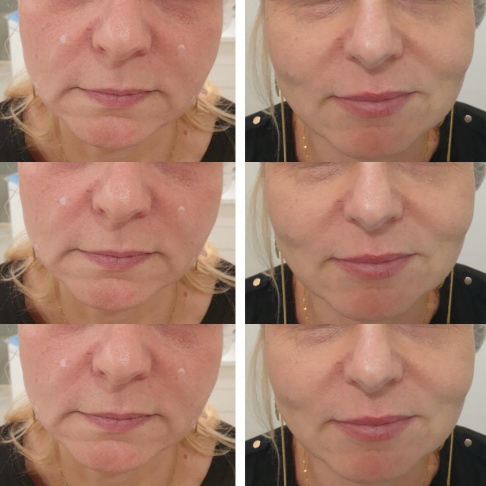Portfolio usługi Zabieg Liftingujący HIFU twarz+szyja
