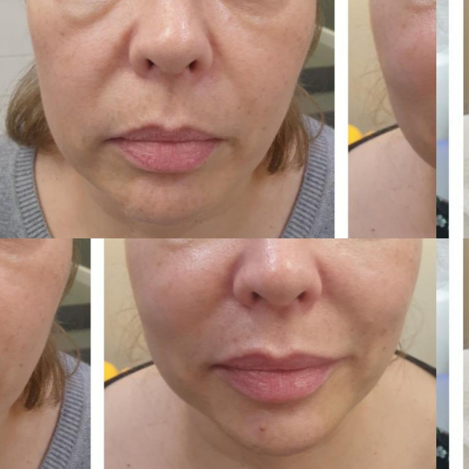 Portfolio usługi Zabieg Liftingujący HIFU twarz+szyja