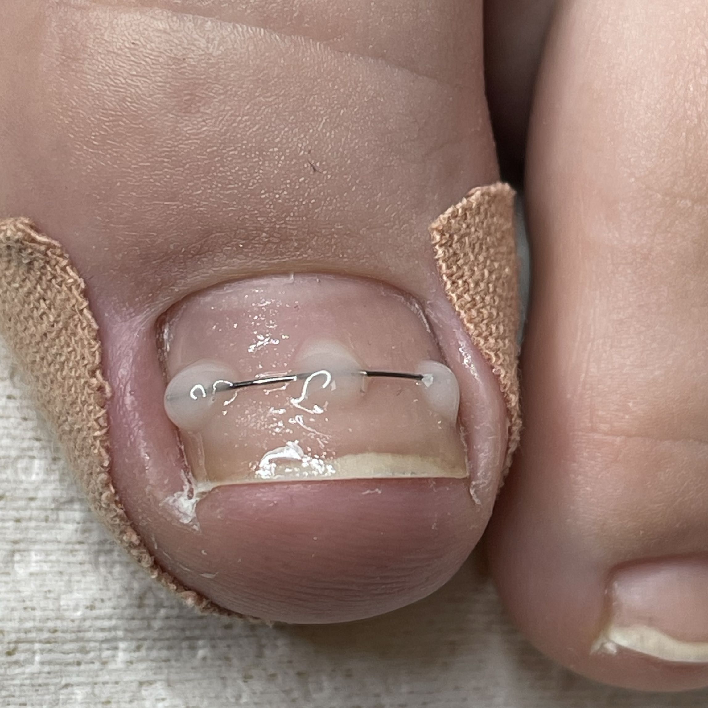 Portfolio usługi Terapia paznokci wrastajacych i wkrecajacych(1wiz
