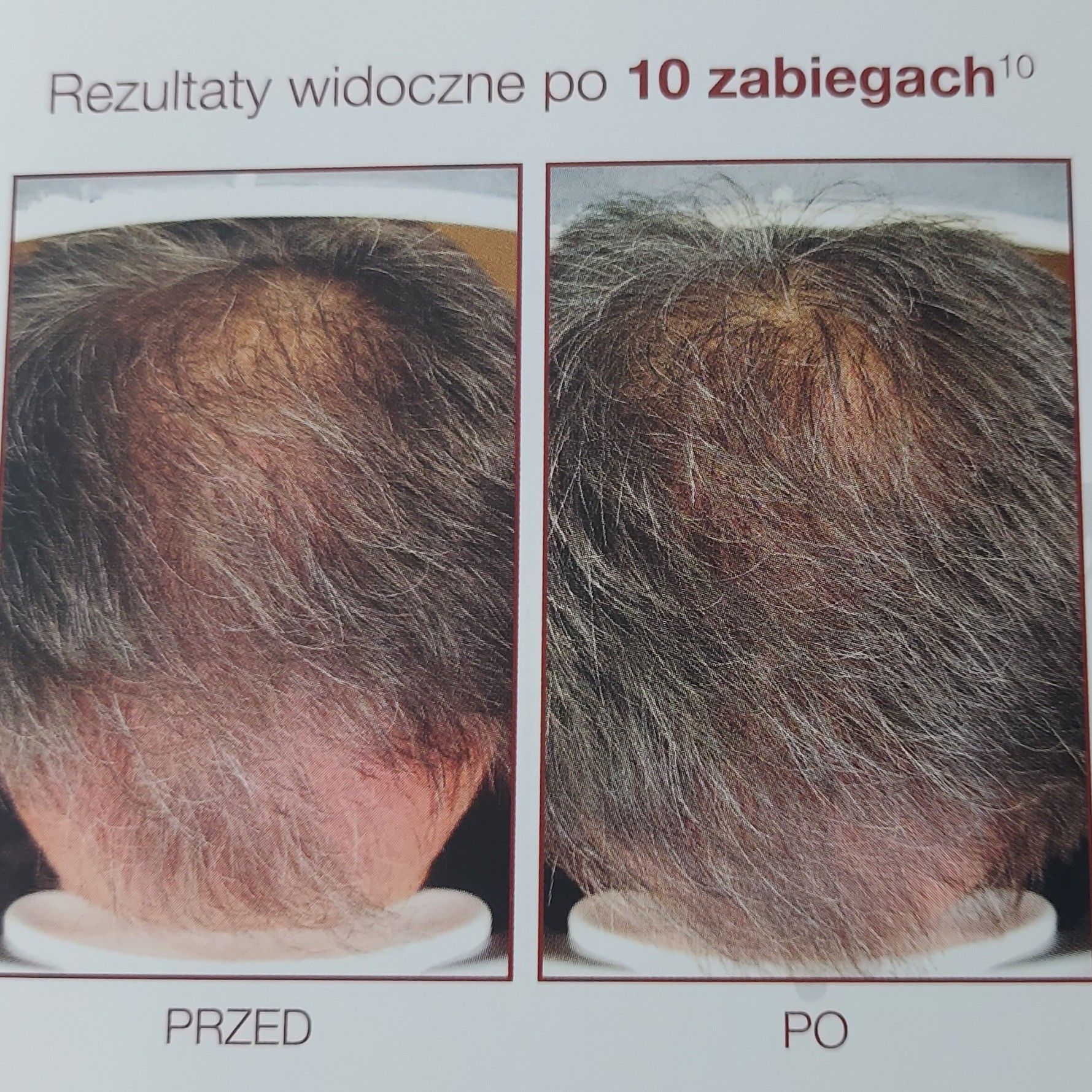 Portfolio usługi Na wypadające włosy, Mezoterapia skóry głowy