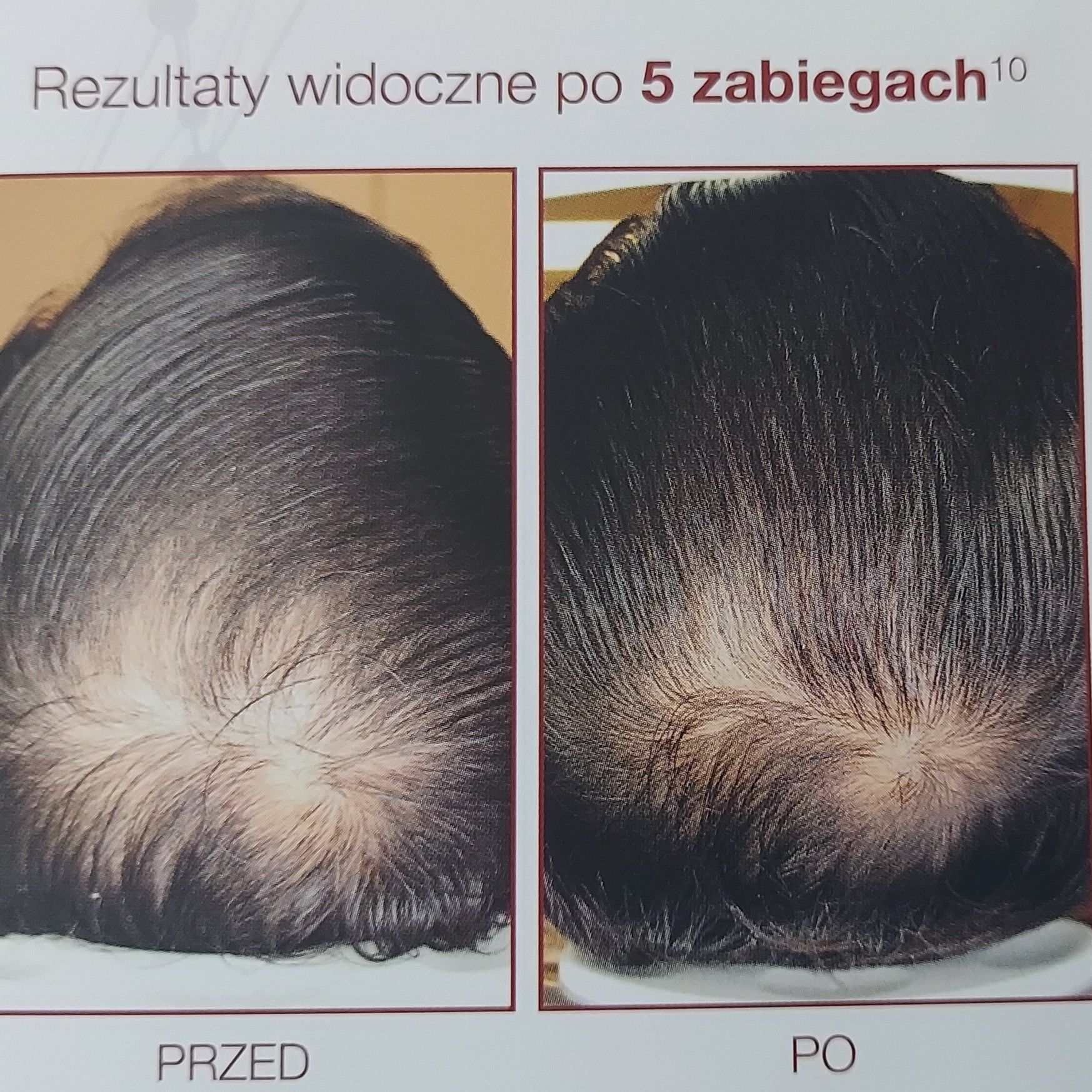 Portfolio usługi Na wypadające włosy, Mezoterapia skóry głowy