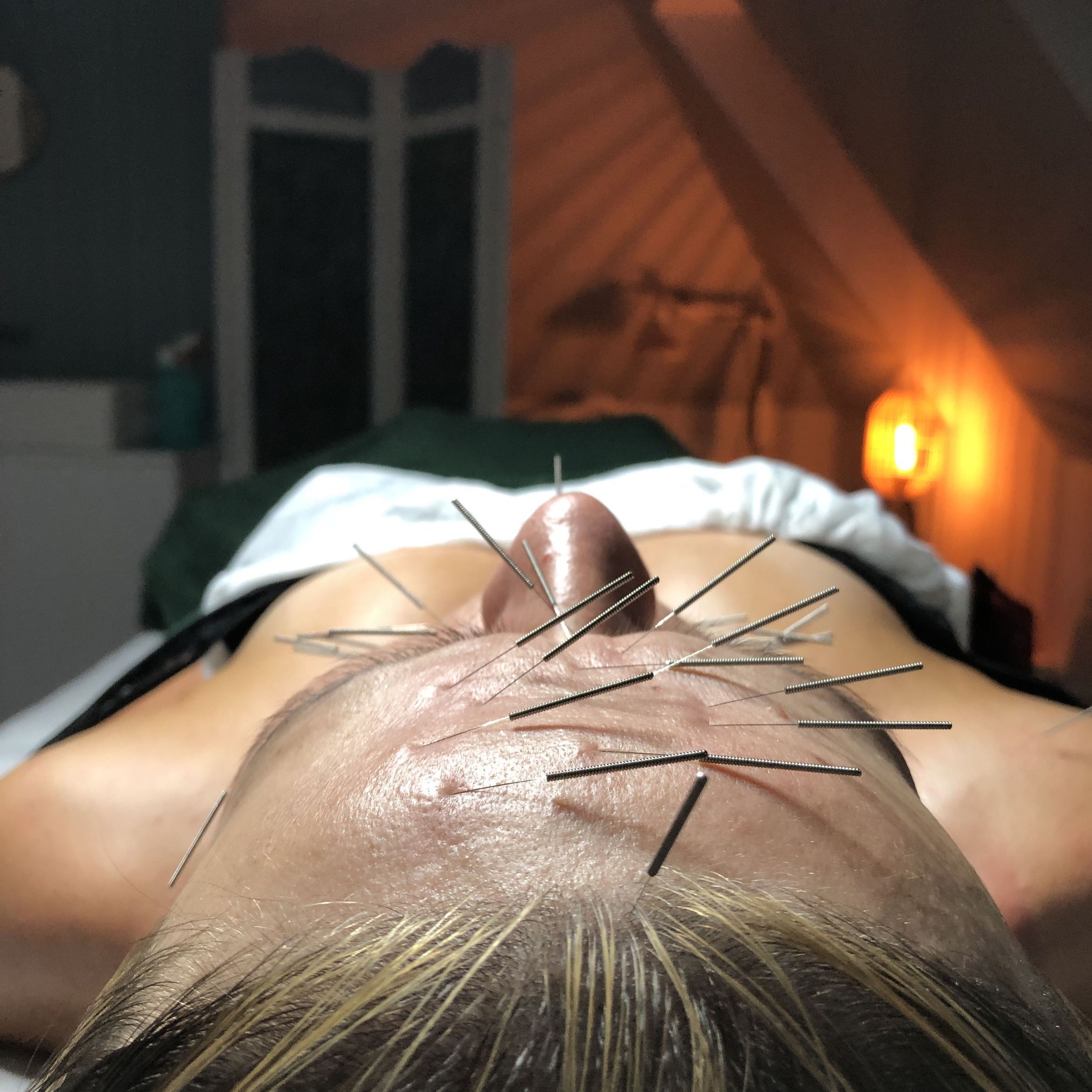 Portfolio usługi Akupunktura kosmetologiczna +autorski masaż