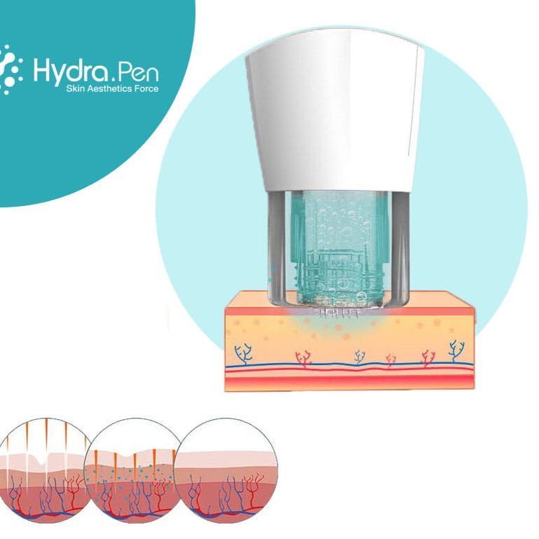 Portfolio usługi Hydra pen Nowość❗️       Zabieg nano mikroigłowy