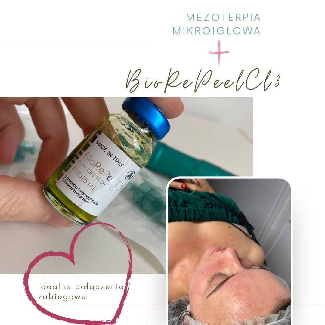 Portfolio usługi Mezoterapia mikroigłowa twarz, szyja i dekolt