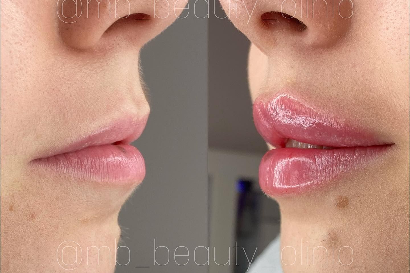 Portfolio usługi Technika autorska Marella lips 1ml