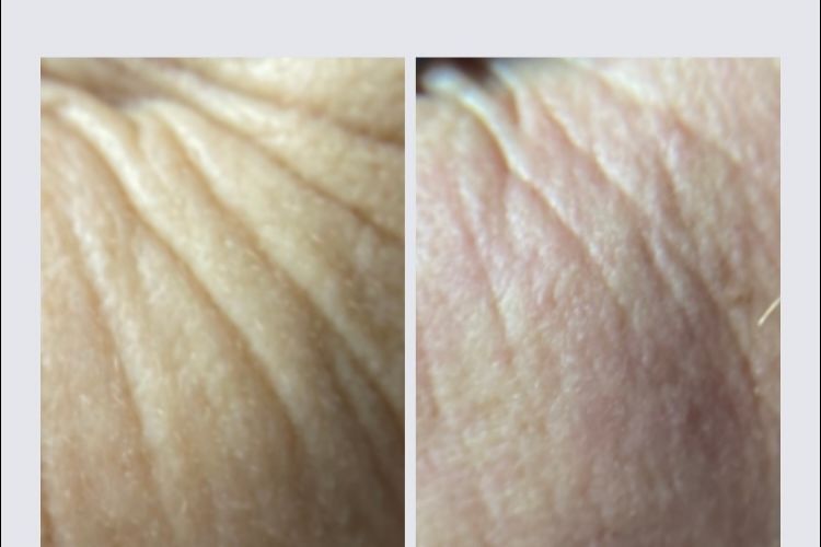 Portfolio usługi Laserowe odmładzanie skóry Resurfacing