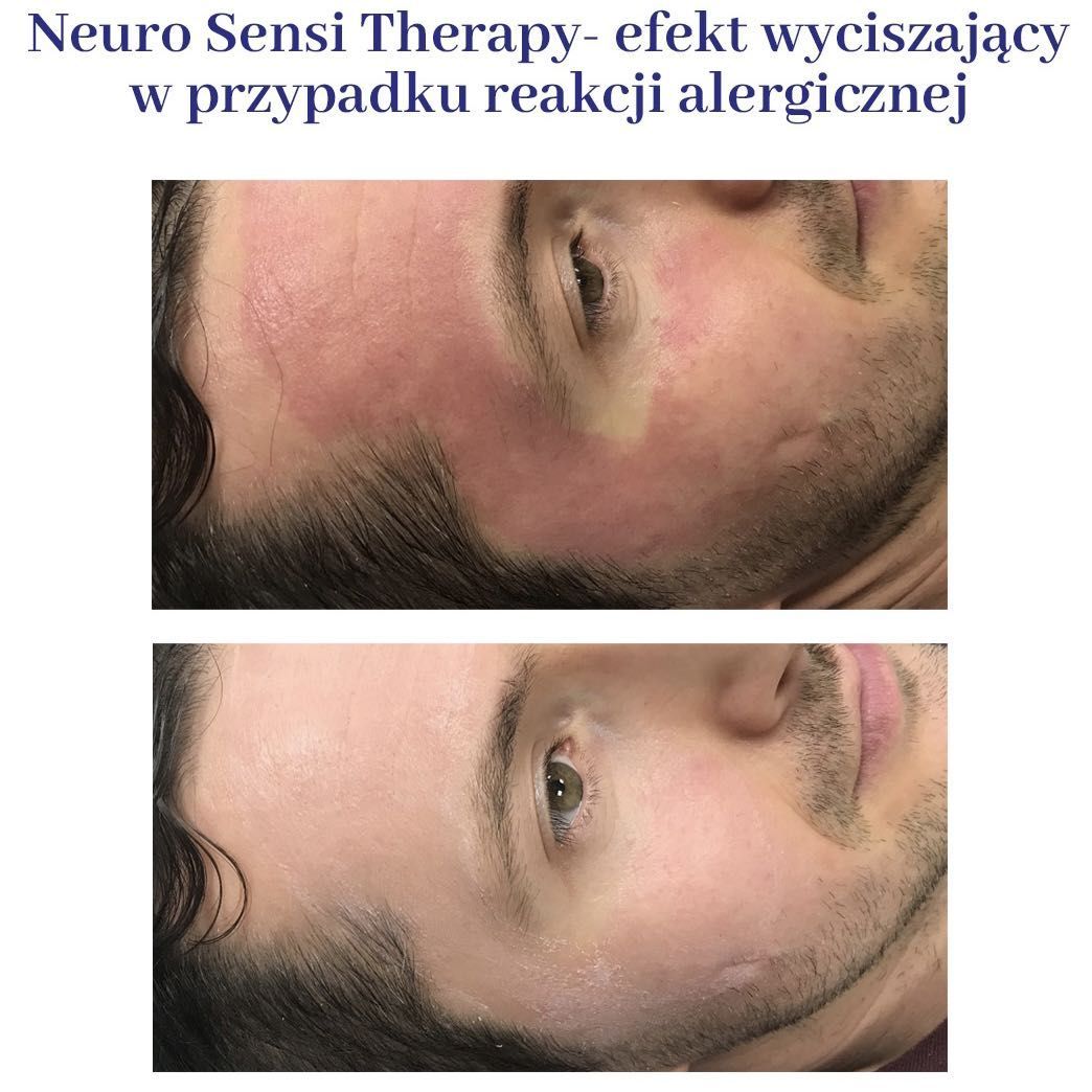 Portfolio usługi Sensi Therapy- skóra wraźliwą, naczyniową