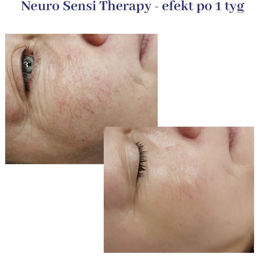 Portfolio usługi Sensi Therapy- skóra wraźliwą, naczyniową