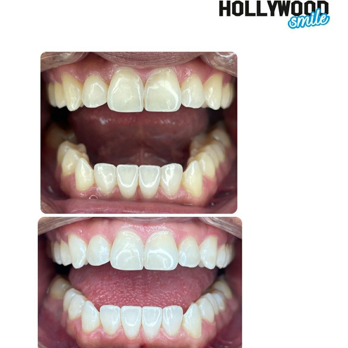 Portfolio usługi Bezinwazyjne Wybielanie Zębów- Promocja Grudniowa