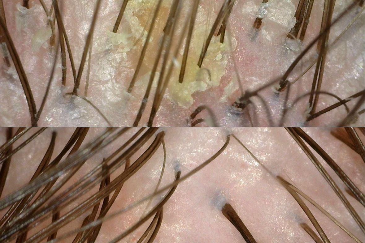 Portfolio usługi Peeling skóry głowy - łupież, łuszczyca, łzs