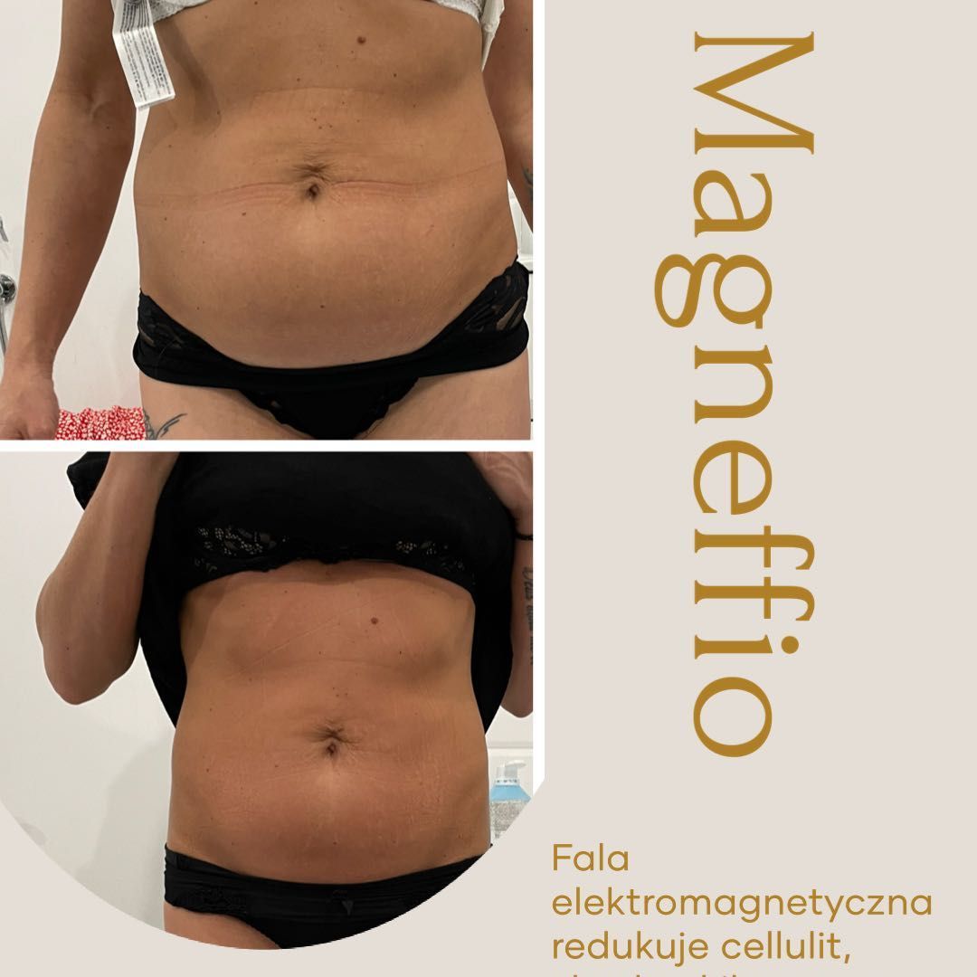 Portfolio usługi Magneffio Spalanie tkanki tłuszczowej
