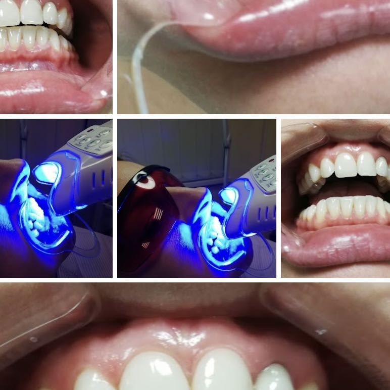 Portfolio usługi Wybielanie zębów lampą LED PROMOCJA