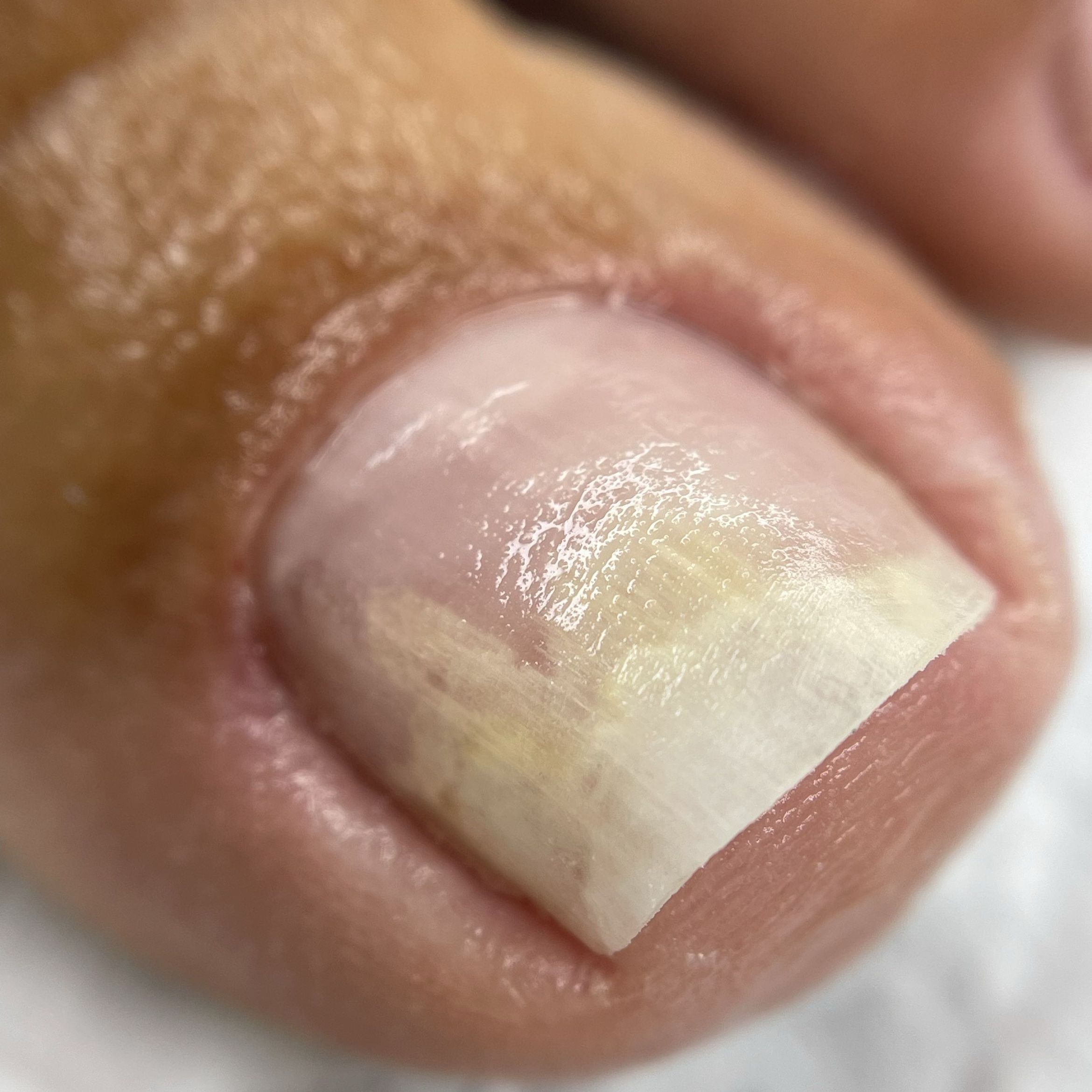 Portfolio usługi Oczyszczenie paznokcia z onicholizą
