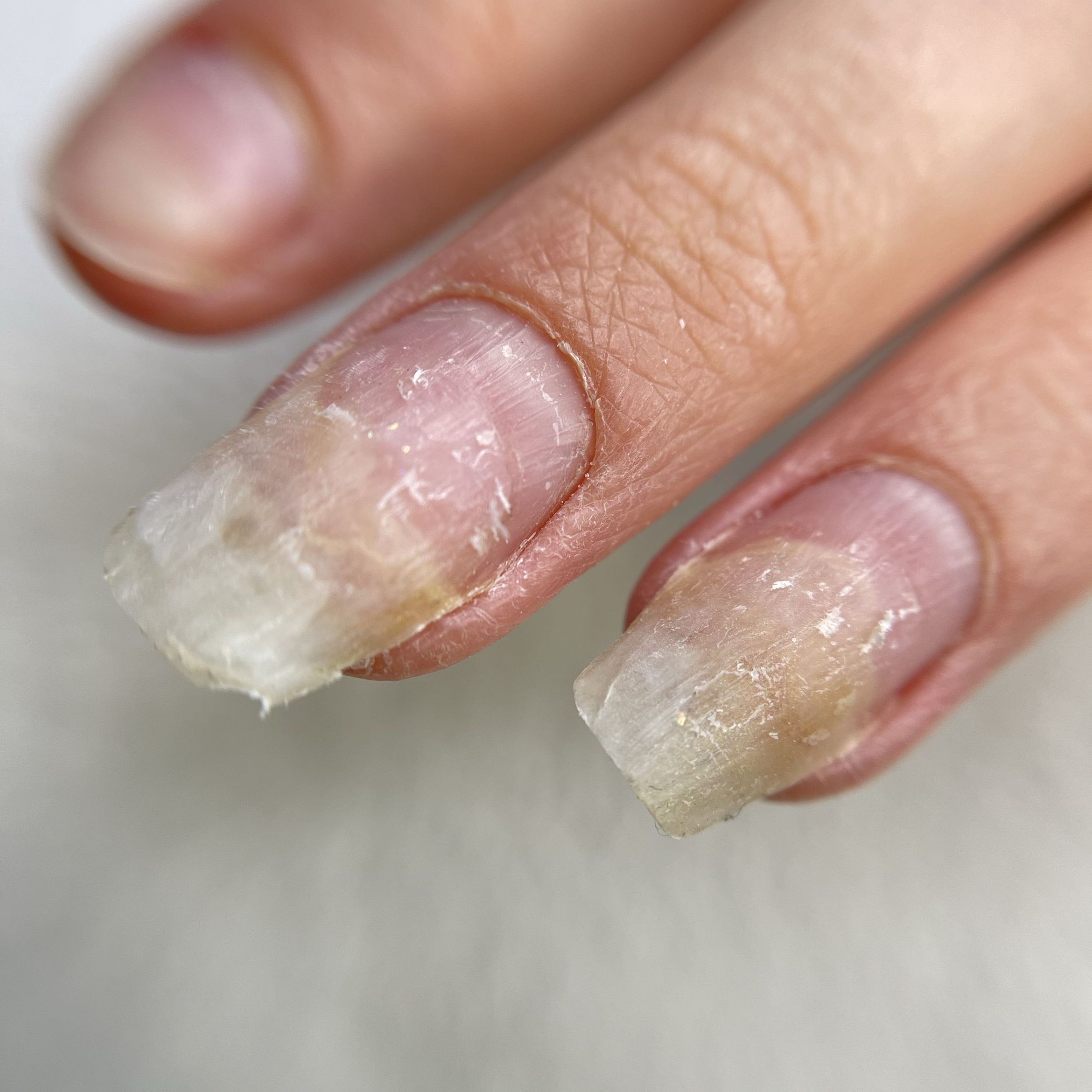 Portfolio usługi Oczyszczenie paznokcia z onicholizą