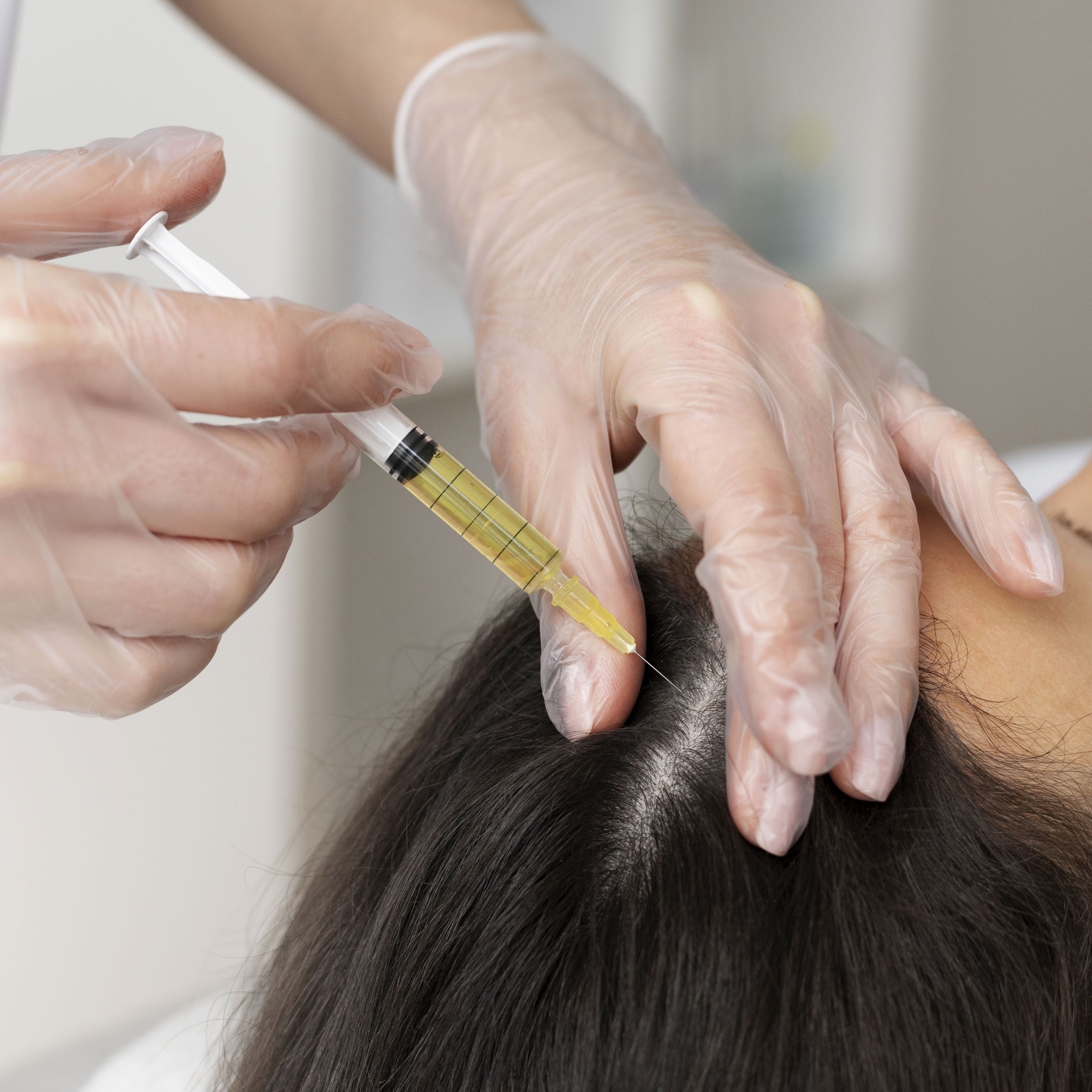 Portfolio usługi Mezoterapia igłowa w skórę głowy RICH HAIR