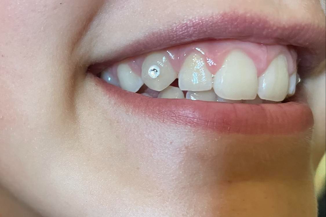 Portfolio usługi Tooth Gems