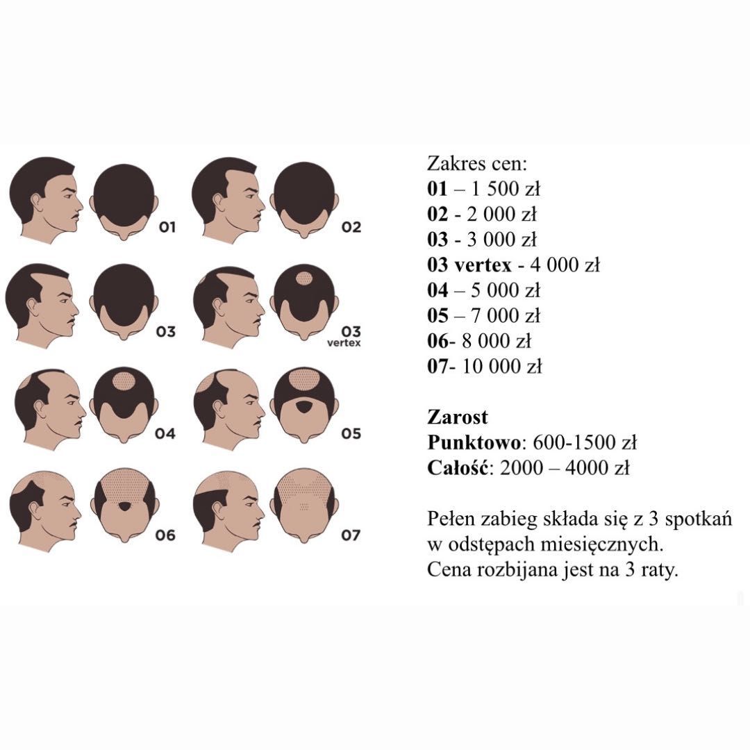 Portfolio usługi Mikropigmentacja skóry głowy