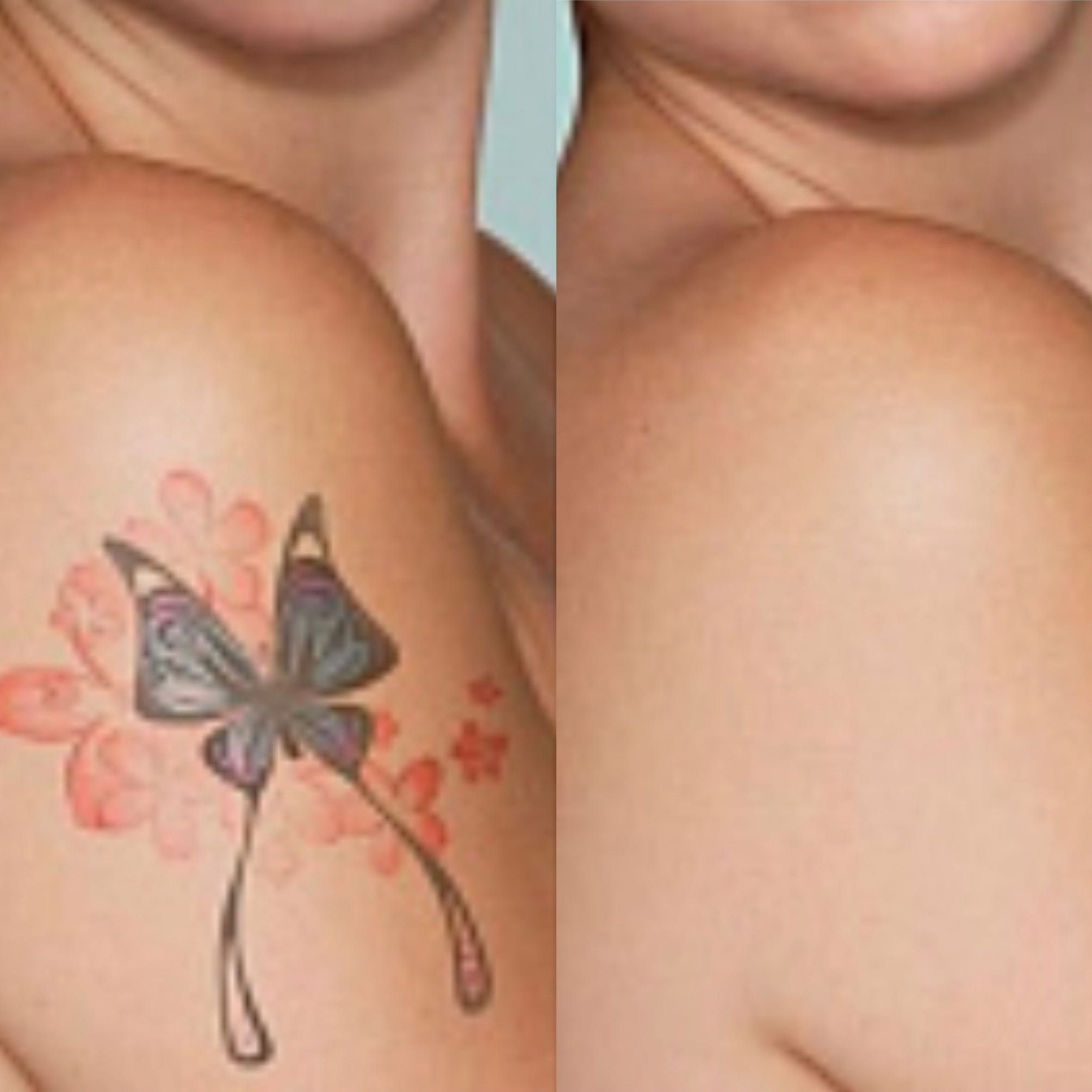 Portfolio usługi Laserowe usuwanie tatuażu Mały 3*5cm
