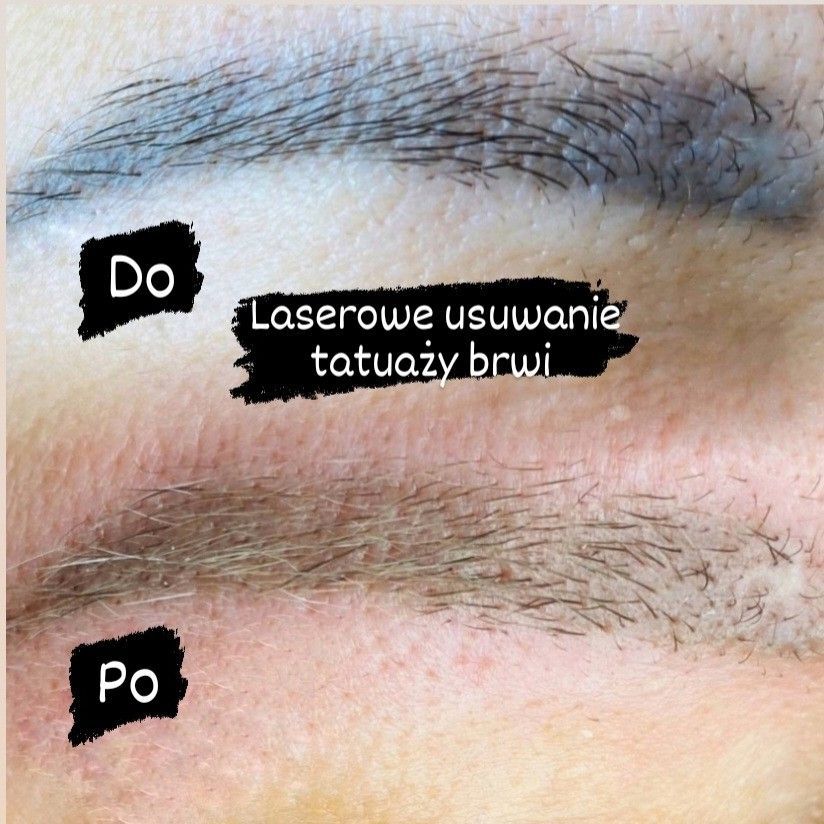 Portfolio usługi Laserowe usuwanie permanentnego makijażu brwi