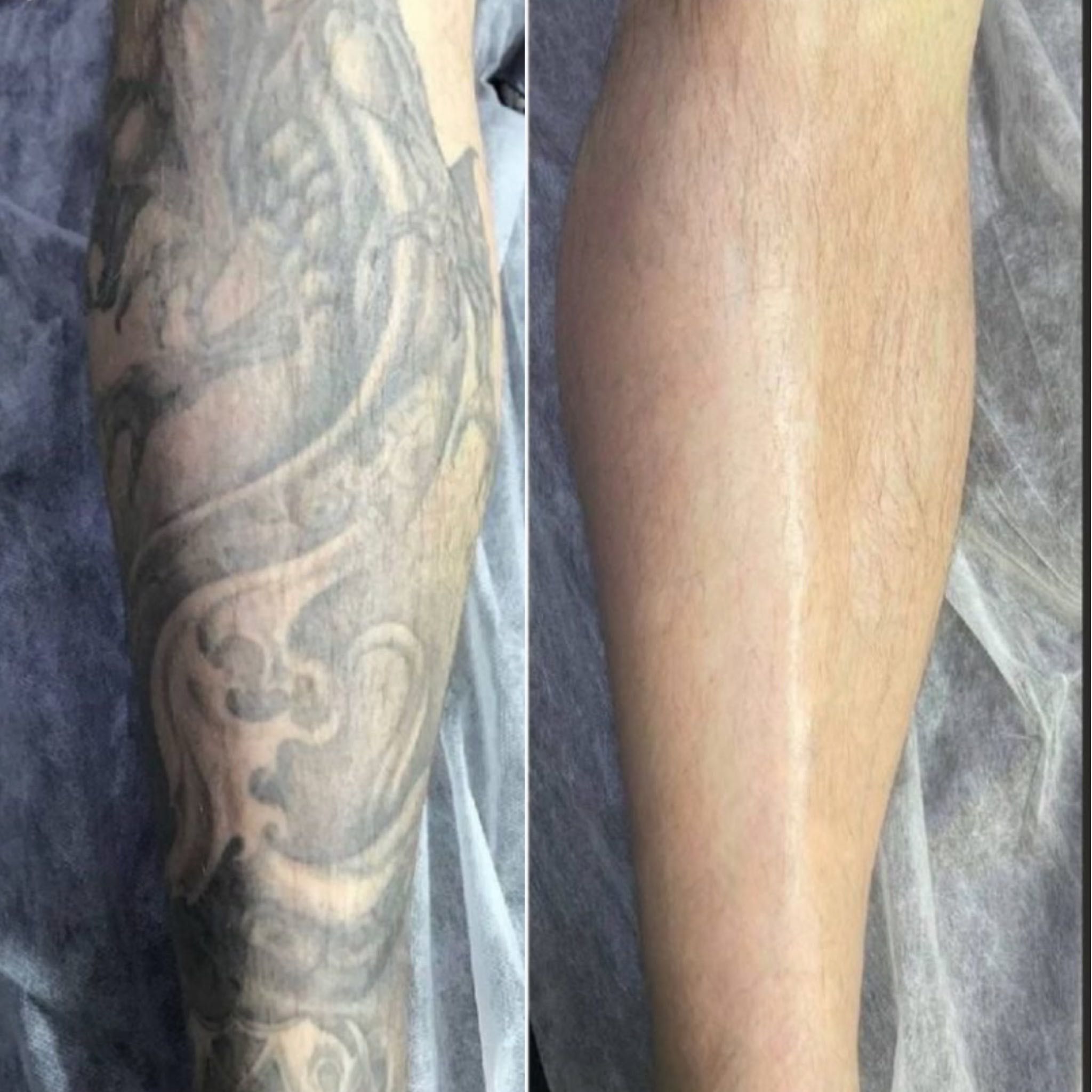 Portfolio usługi Laserowe usuwanie tatuażu Duży 15*15cm