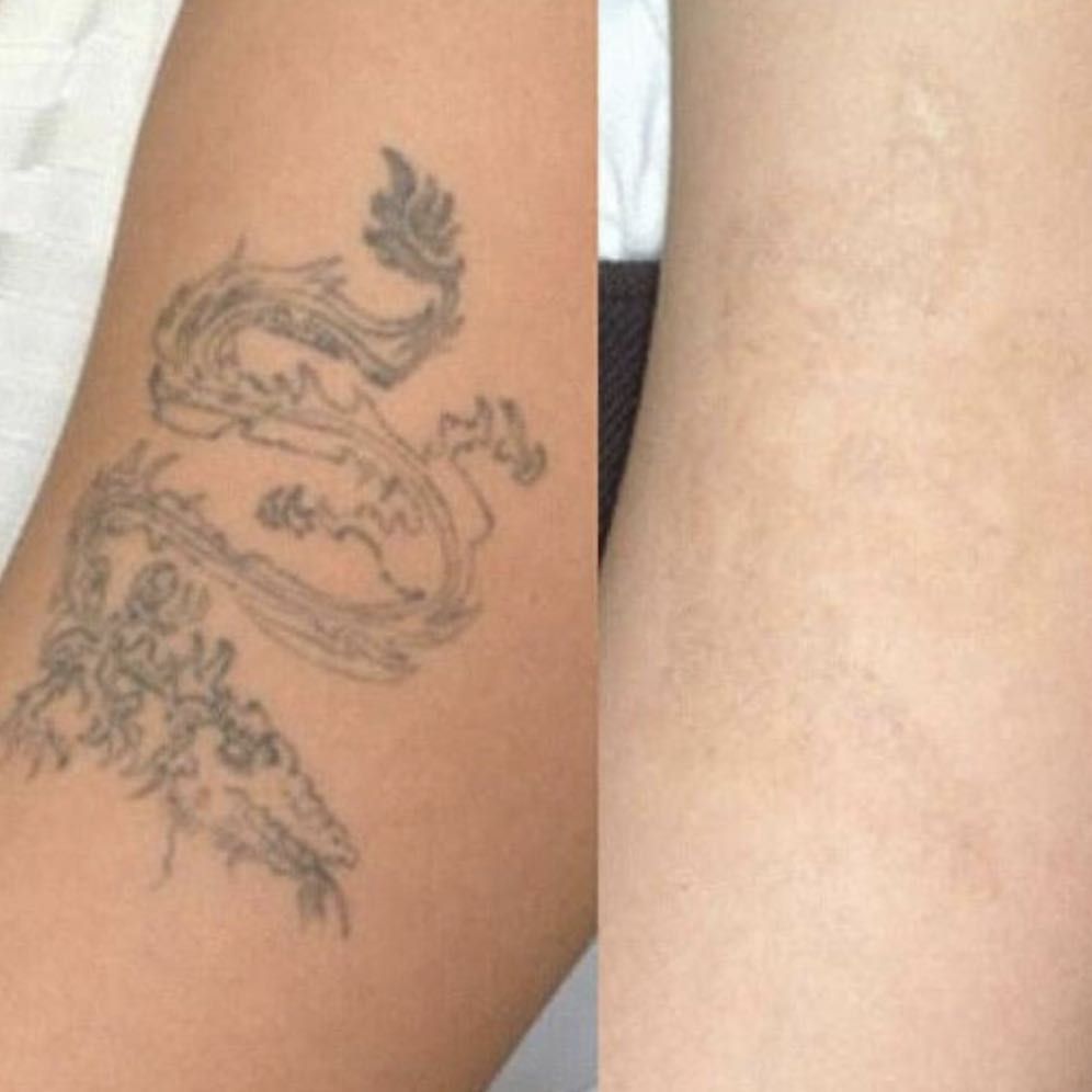 Portfolio usługi Laserowe usuwanie tatuażu średnio-duży 10*10cm