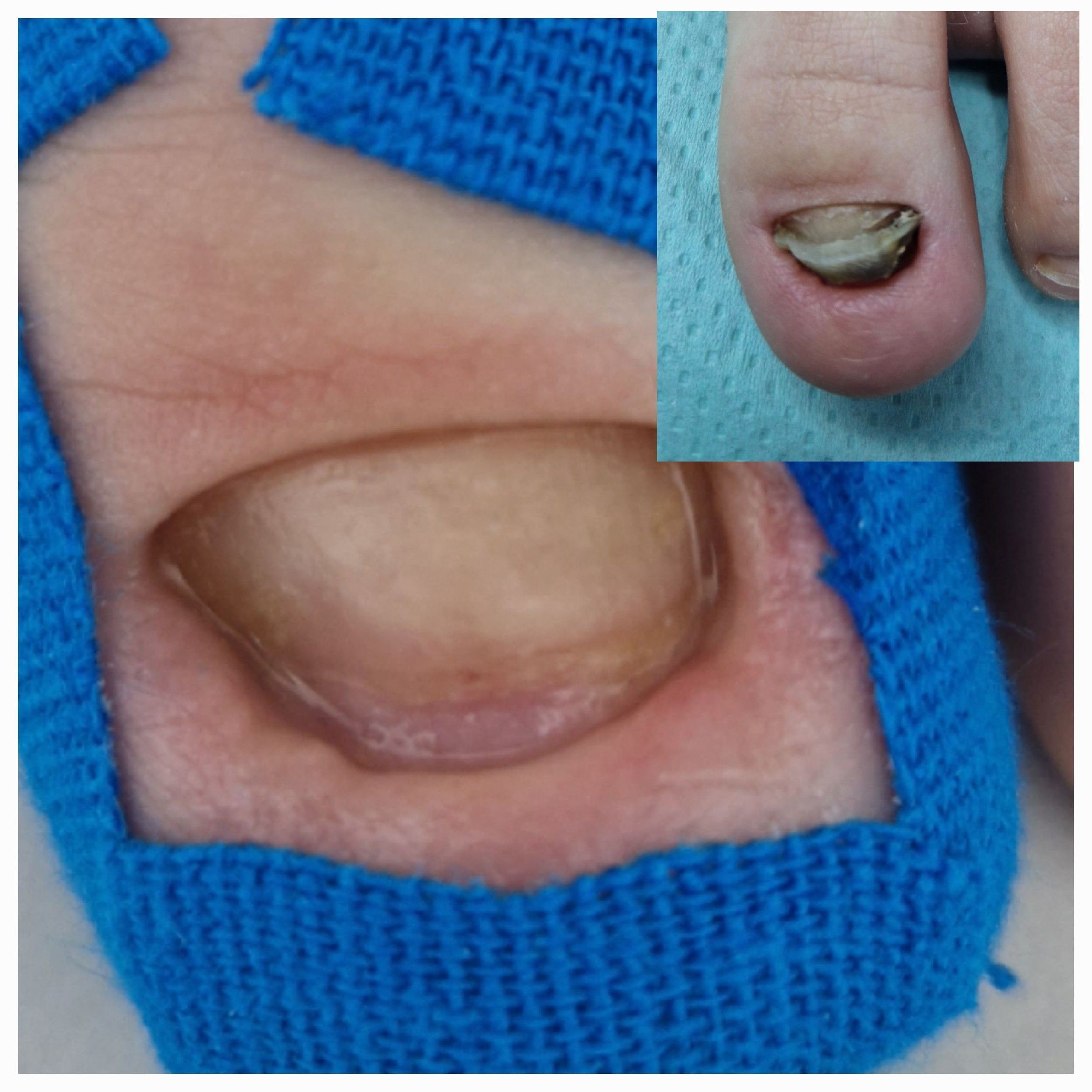 Portfolio usługi Opracowanie paznokci zmienionych chorobowo