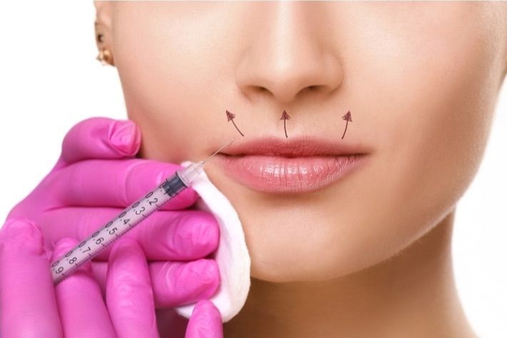 Portfolio usługi Botox Lip Flip (wywinięcie /powiększenie ust )