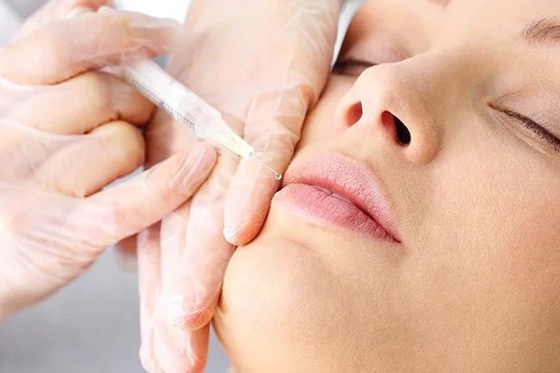 Portfolio usługi Botox - Uniesienie kącików ust