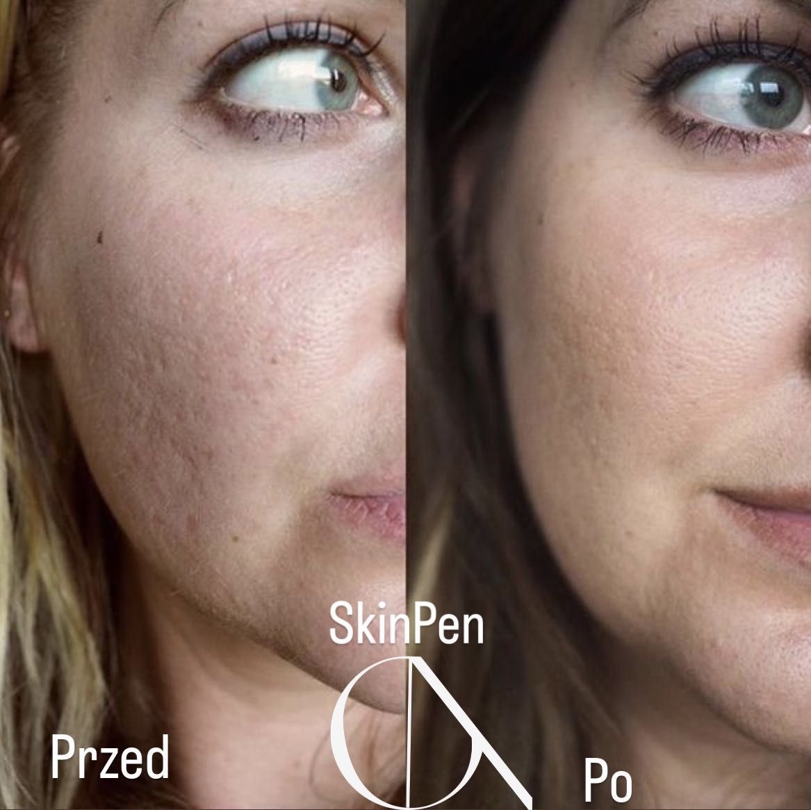 Portfolio usługi SkinPen