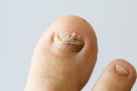 Portfolio usługi Oczyszczenie paznokci zmienionych chorobowo