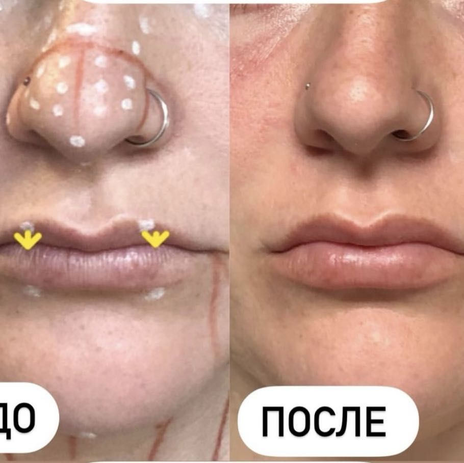 Portfolio usługi Redukcja i korekta nosa