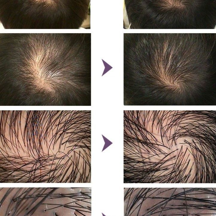 Portfolio usługi Dr.Cyj- wypadanie włosów 4x. 1ml Oszczędzasz 400zl