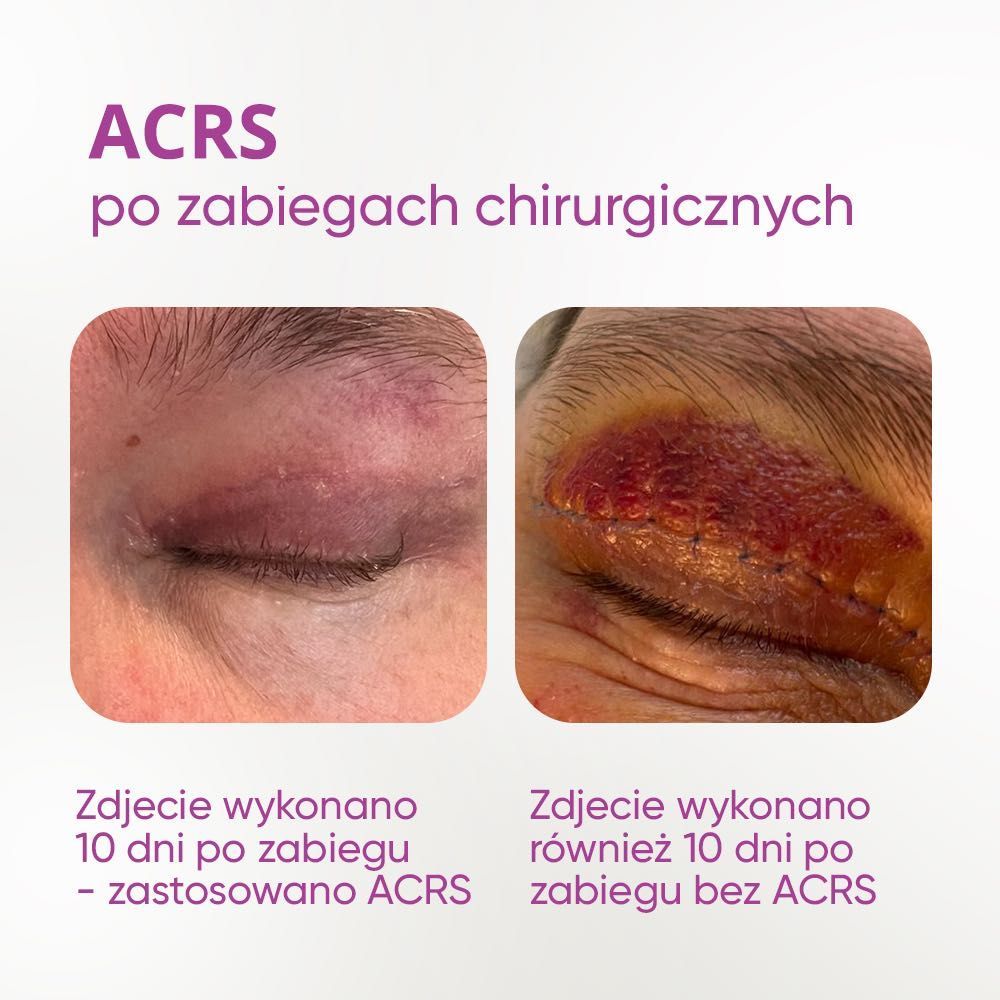 Portfolio usługi ACRS Serum Cytokinowe (wypadanie włosów, blizny)