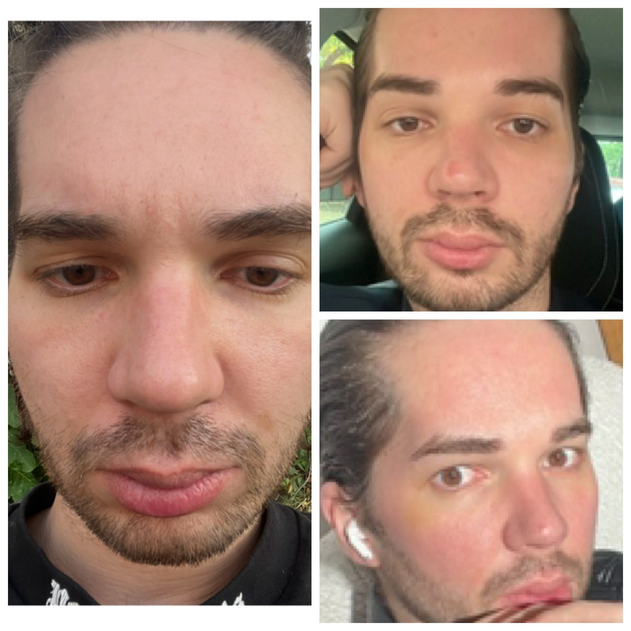 Portfolio usługi Full Face Botox