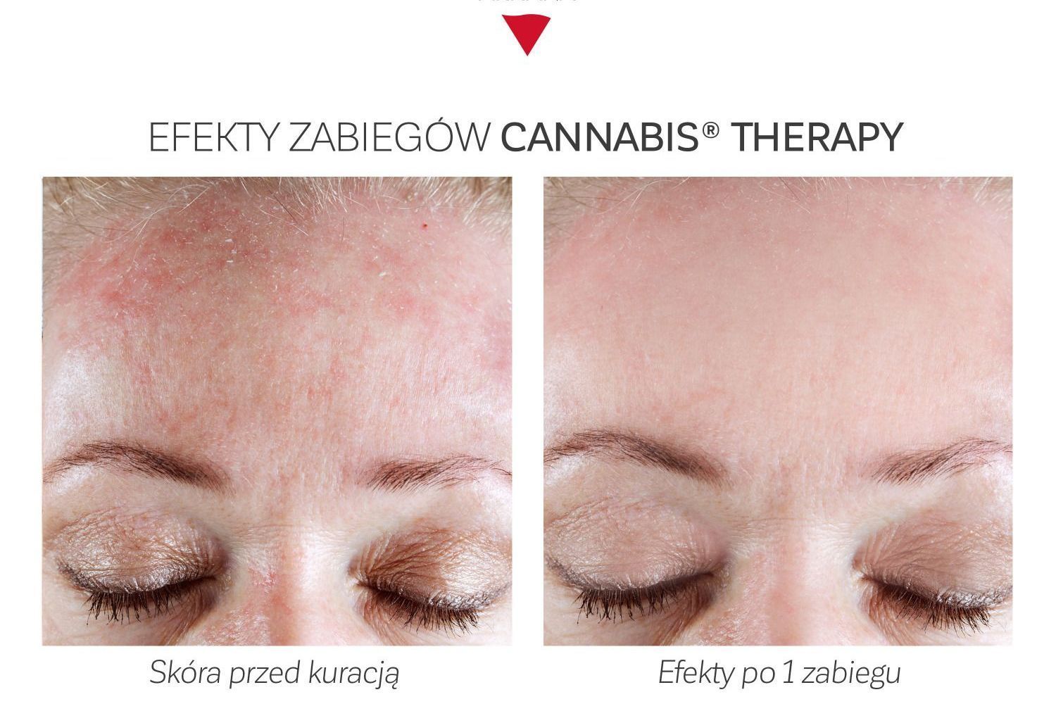 Portfolio usługi Neuro Cannabis Therapy - skóra zestresowana